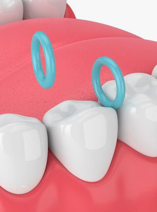 Separators or Spacers For Ortho Treatment Irvine